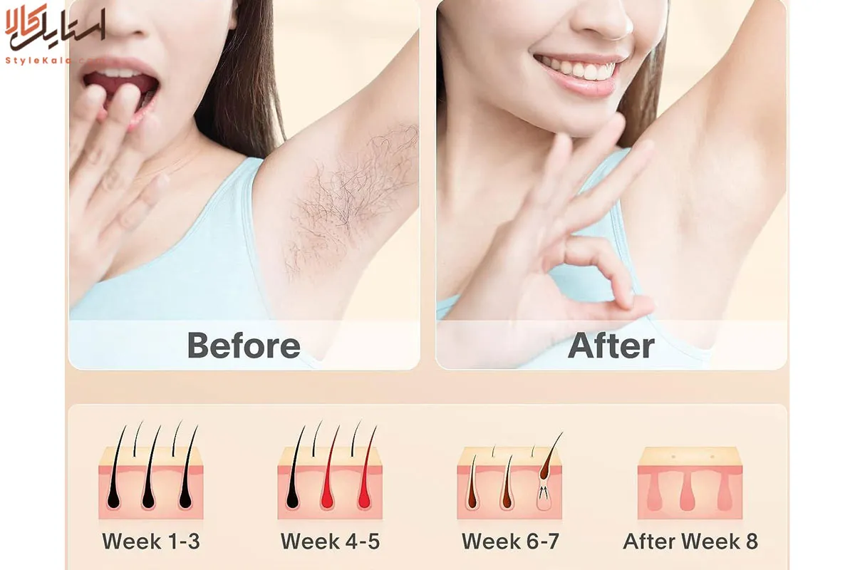 نتایج ۴، ۸ و ۱۲ هفتهای لیزر خانگی فیلیپس و براون